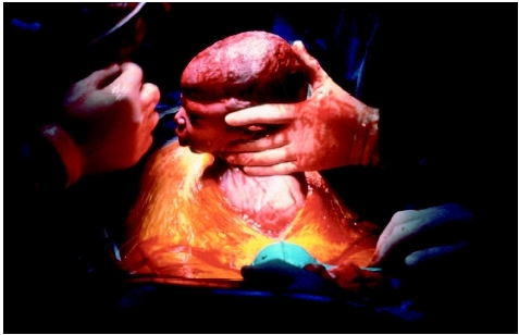 This baby is being delivered by cesarean section. (Photograph by John Smith. Custom Medical Stock Photo Inc..)