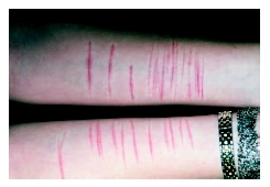 Self-inflicted lacerations on the arms of a teenage girl. (Photo Researchers, Inc.)