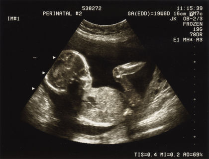 Prenatal Development - baby, stages 